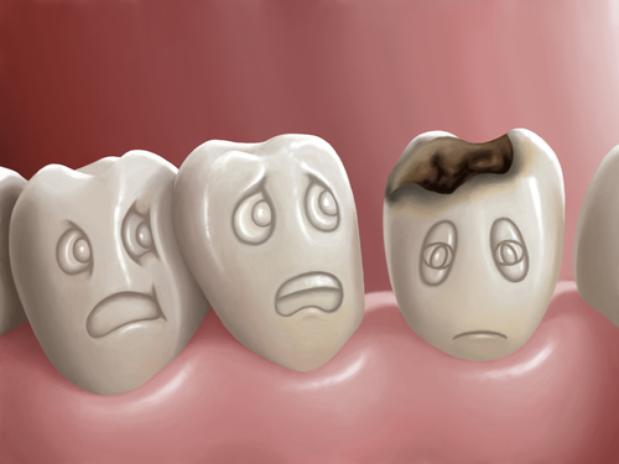caries